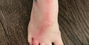 علامة حمراء على الجلد.. قد تكون دلالة على هذا المرض