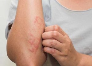 الأمراض الجلدية الأكثر شيوعًا في الصيف