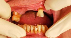 أمراض الفم تصيب ما يقرب من نصف البشرية