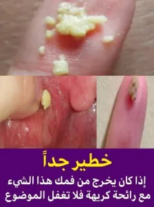 اذا كان يخرج من فمك هذا الشئ مع رائحة كريهة فلا تغفل الموضوع