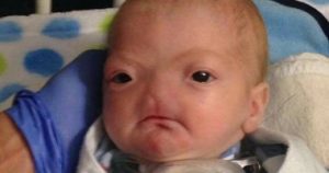 بالصور.. ولادة طفل بدون أنف يثير جدل علي مواقع التواصل