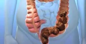 عاني 22 عام من الامساك ، ولم يصدق الاطباء ما رأوا عندما فتحوا بطنه