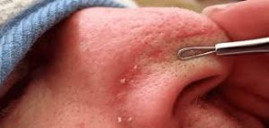 إزالة الرؤوس السـ.ـوداء