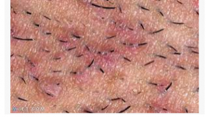 طرق التخلص من شـعـر الجـسم