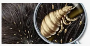 بعد ان وصلت سعر القمل 15 دولار تعرف علـ.ـى فوائده