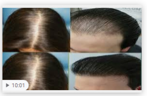 مكون أوصانا به النبي صلى الله عليه وسلم ينبت ويمنع تساقط الشعر ويملأ الفراغات ،شاهد الطريقة الصحيحة