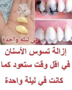 صدق أو لا تصدق إزالة تسوس الأسنان في اقل وقت ستعود كما كانت في ليلة واحدة من ثواني