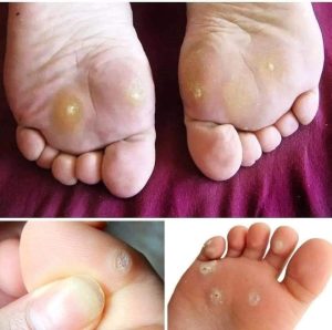 علاج مسمار القدم