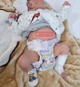 حالة نادرة جداً.. ولادة طفل يحمل توأمه في بطنه!