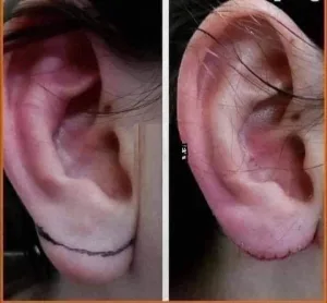 حقيقـة بيع شحمة الأذن بـ20 مليون دولارخبير يوضح