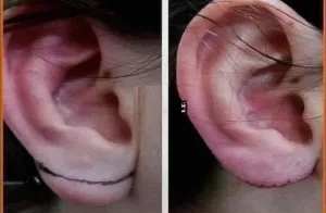 بيع شحمة الأذن بـ20 مليون دولار.. خبير يوضح التفاصيل