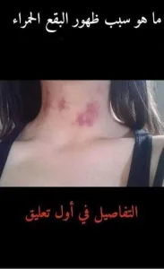 ما هو سبب ظهور البقع الحمراء مباشرة بعد العـــ.لاقة الزوجـــ.ية الأجابة سوف تدهشك