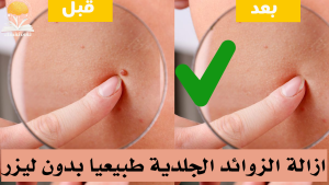 علاج الزوائد الجلدية بالفيديو وصفات تخلصك منها بشكل طبيعي وأمن