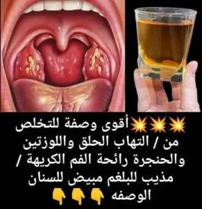 التهاب الحلق