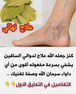 دوالي الساقين