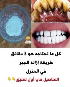 أزالت جير الأسنان