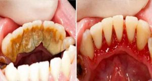 كيف يتم ازالة الرواسب الجيرية ونصائح لمنع تراكمها