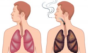 علامة “غير عادية” تظهر في أصابعك قد تدل على سـ،ـرطـ،ـان الرئة