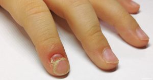 تركيبة بسيطة هتساعدك فى التخلص من فطـ،ـريات الأظـ،ـافر