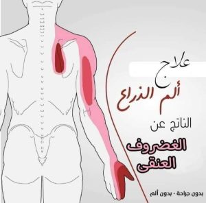 عــــ..ـــلاج الـــــ…ـــم الكتف والذراع/السبب الخفي وراء الم كتفك وعلاجه