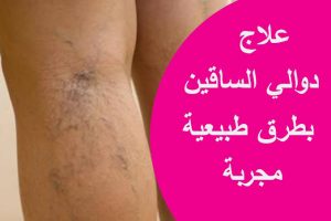 كـ،ـنز جعله الله تعالى لعلاج دوالـ،ـي السـ،ـاقين