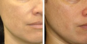 احسن الوصفات لعلاج اسمرار البشره من الشمس