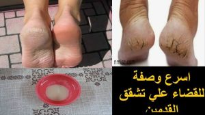 تخلص من الكعوب المتشققة واحصل على أقدام جميلة