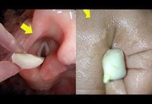 شاهــ،دوا طريقة إزالـ،ـة البواسـ،ـير بدون جـ،ـراحة وفي 3 ايام ستخــ،ـتفي البواسـ،ــير