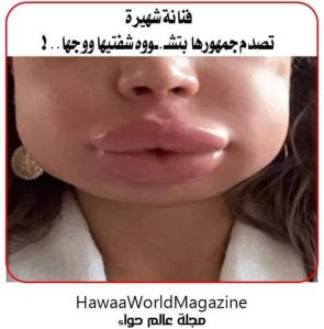 فنانة شهيرة تصـ ـدم جمهورها بتـ ـشووه شفتيها ووجها