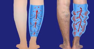 طريقة علاج عرق النساء