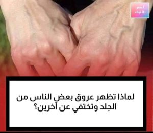ظـ،ـهـ،ـور عـ،ـروق اليد لدى بعـ،ـ،ـض الأشـ،ـ،خـ،ـاص