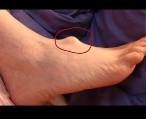 A lady spotted a lump on her foot when she was 15 years old, but she chose to ignore it.