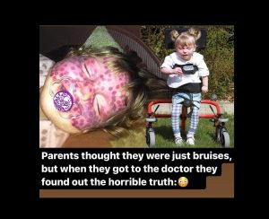 Parents respond to strangers who jump to hurtful conclusions because of their daughter’s rare skin disease