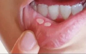 تقرحات الفم اسبابها و علاج التهاب الفم