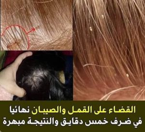 مع دخـ،ـول المدارس .. أسـ،ـرع طريقة للتخــ،ـلـ،ـص من القمل