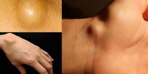 It’s vital to know the following if you have oily globules beneath your skin