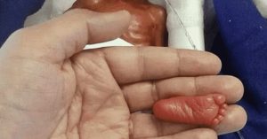 She weighed only 1 pound at birth and the doctors thought she would not survive. This is her impressive journey