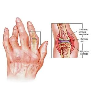طريقه علاج الام المفاصل بالاعشاب