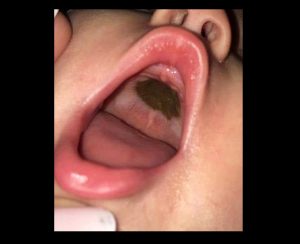 She discovered a black spot in her daughter’s mouth and went to the hospital in a hurry.