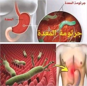 8 أعراض لسر.طان المعدة في مرحلة مبكرة تنبهك لضرورة التوجه إلى الطبيب