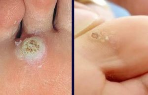 إليكم أسهل وأقوى طرق علاج مسمار القدم