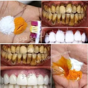 تبييض الاسنان فى ثوانى