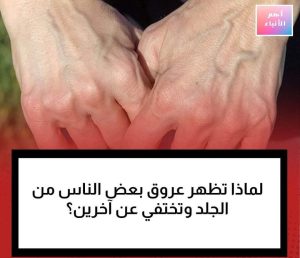 لماذا تظهر عروق بعض الناس من الجلد وتختفي عن آخرين