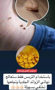 بشمعة واحدة تخلصي من هذه الزوائد الجلدية