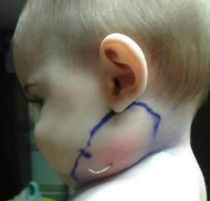 شئ في رقبة الطفل