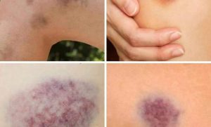 6 أعراض تدل على وجود جلطات بجسمك