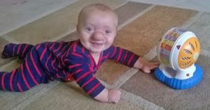 بالصور.. حالة نادرة لطفل تصيبه بأنف "بينوكيو" نتيجة ثقب بالمخ