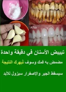 طرق لتبيض الاسنان وازالة الجير