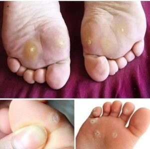 أقوى علاج طبيعي لمسمار القدم بدون أدوية.. 13 وصفة بمفعول صيدلي تخلصك من الألم في 3 أيام!