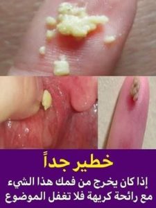 خطير جداً ... إذا كان يخرج من فمك هذا الشيء ... مع رائحة كريهة ...فلا تغفل الموضوع